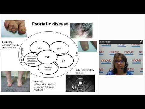 The Diagnosis and Management of Psoriatic Arthritis