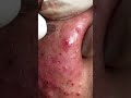 Clean Acne for the boy with acne inflammation  official video  Part1