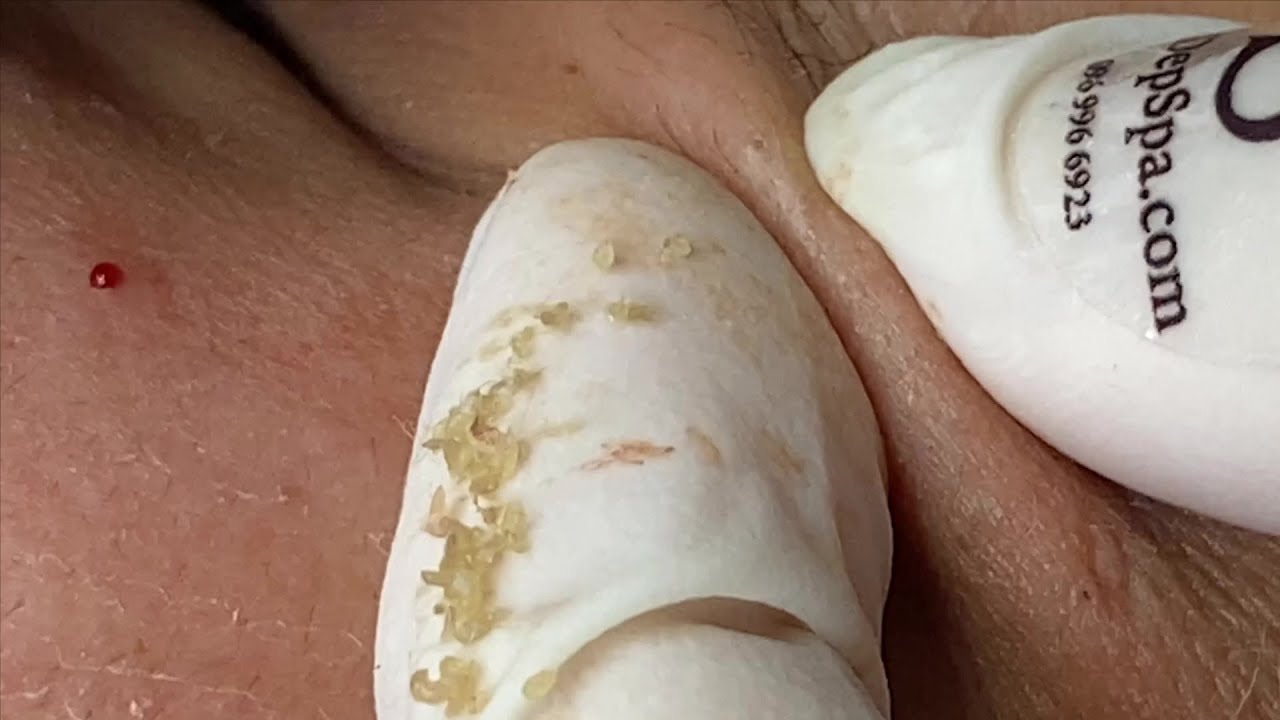 Acne Treatment On Skin | Điều Trị Mụn Trên Da - SacDepSpa#89
