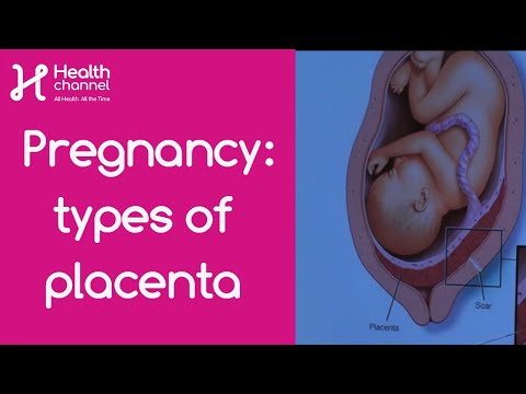 Video: Wat is een graad 1 placenta?