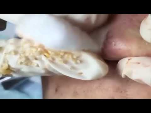 Severe Cystic Acne Removal Treatment 