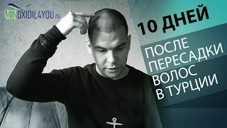 10 дней после пересадки волос на голове. Результат после операции по пересадке волос в Турции 2018