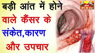 बड़ी आंत में होनेवाले कैंसर के संकेत कारन और उपचार // #Cancer Treatment#जीवन जीने की कला