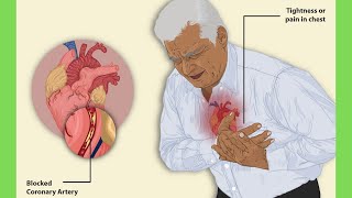 Widowmaker heart attack: Everything you need to know.