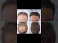 Hairline and Crown Transformation- Dr. De Freitas