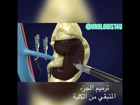 استئصال الكلية الجزئي لورم باستعمال الروبوت الآلي /Robotic Partial Nephrectomy Animation