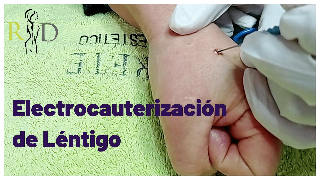 Electrocauterización de Léntigo, Lunares, Verrugas - YouTube