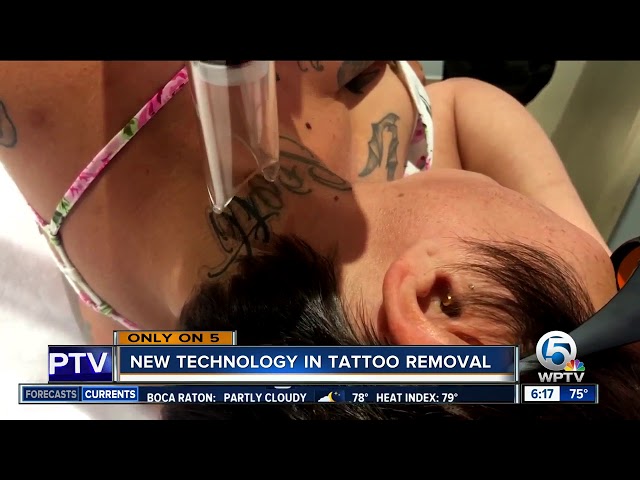 Laser Tattoo Removal Aftercare – Infinity Laser Spa