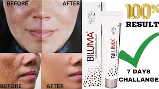 Biluma Cream Review| Biluma Skin Brightening cream | Pigmentation Removal cream| Pigmentation Cream