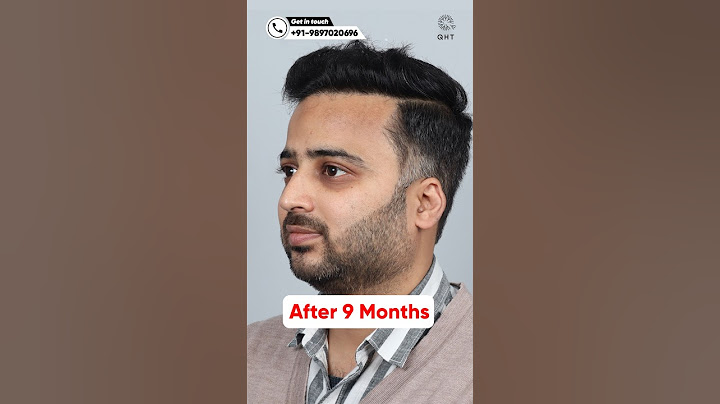 Nine Months Hair Transplant Results | Latest Fue Technique #shorts #viral #hair transplant
