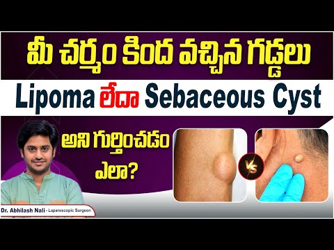 Difference Between Lipoma And Sebaceous Cyst | Reason For Lumps In Body | Dr Abhilash Nali