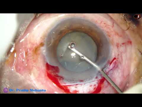 Plan A- Phaco, Plan B- SICS: Managing a Hypermature morgagnian cataract  with extremely weak Zonule.