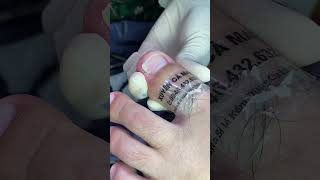 Satisfying ingrown toenail ex _65 - XUYEN CA MAU  #nail #nailart #nail2023