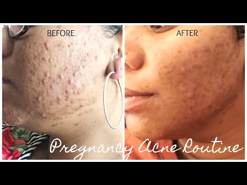 PREGNANCY ACNE ROUTINE THAT WORKS!