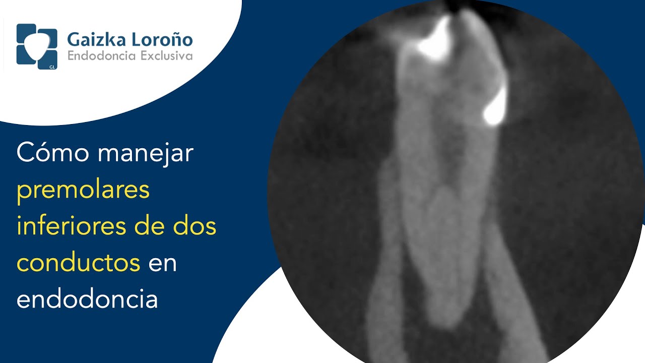 Cómo manejar premolares inferiores de dos conductos en endodoncia