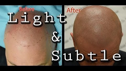 Scalp Micropigmentation in Arizona