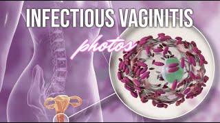 Infectious Vaginitis (Photos) - CRASH! Medical Review Series