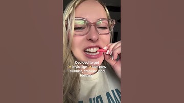 How it feels to have invisalign?