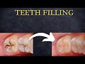 Teeth Filling Procedure
