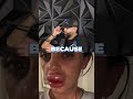 Disastrous Cosmetic Complications: Facial Transformations Gone Wrong