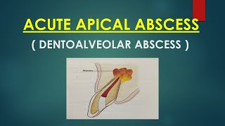 Acute Apical Abscess ( Endodontics)