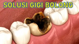 Tambalan gigi bertahan berapa lama | Dokter Gigi Channel
