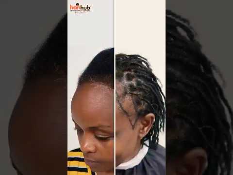 Eunice's hair restoration journey