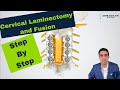 Posterior Cervical Laminectomy and Fusion - Procedure details, recovery, and expectations.