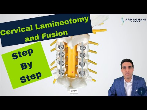 Posterior Cervical Laminectomy and Fusion - Procedure details, recovery, and expectations.