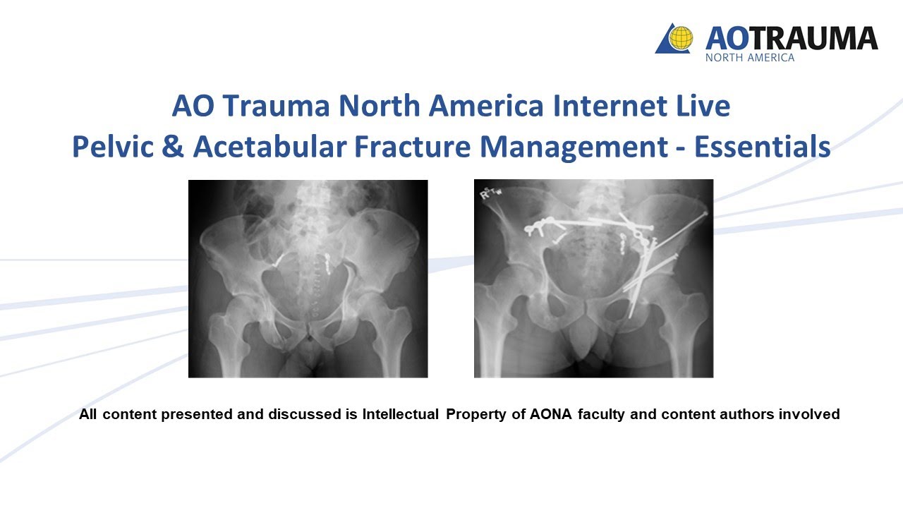 PPT - Pelvic Ring Injuries: Definitive Management PowerPoint Presentation -  ID:3211934