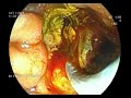 ERCP : PERIAMPULLARY CARCINOMA | SEMS DEPOLYMENT |