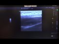 Suprascapular Nerve Block- Ultrasound Guided