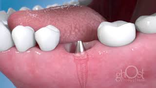 Ghost Productions - Partial Arch - Dental Bridge