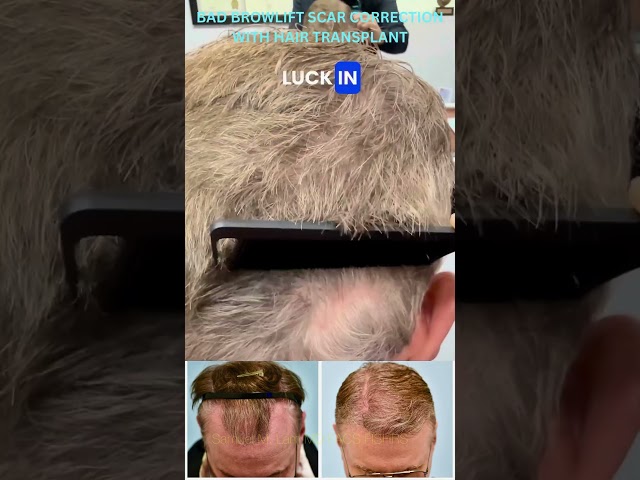 Brow lift Scar Hair Transplant Correction with Close-up Comb Through of Both Donor & Recipient Areas