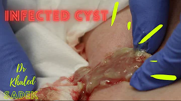 Infected back cyst. Dr Khaled Sadek. LipomaCyst.com