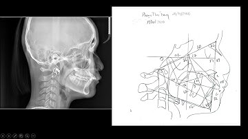 Case lâm sàng Low Angle không nhổ răng với sự kết hợp Bio - Meaw