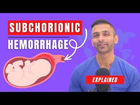 Subchorionic Hemorrhage Explained