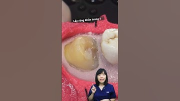 Quy trình nhổ răng khôn mọc lệch | Dr Anh Thư
