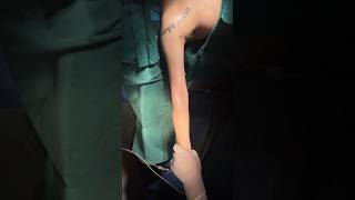 #Waist and abdomen circumference #liposuction #Thigh liposuction