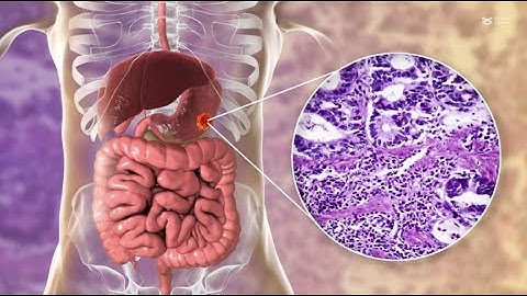 Hypoxia induces neutrophil extracellular trap formation to drive gastric cancer growth