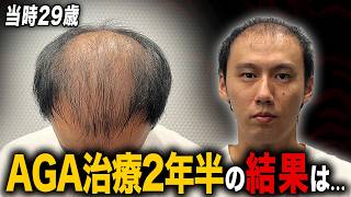 【驚愕】29歳からAGA治療薬を2年半飲み続けた結果