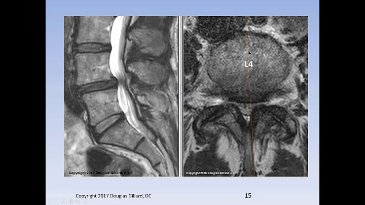 Lumbar Spinal Stenosis, Cauda Equina Syndrome, Sci...