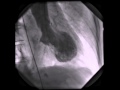 Takotsubo Cardiomyopathy