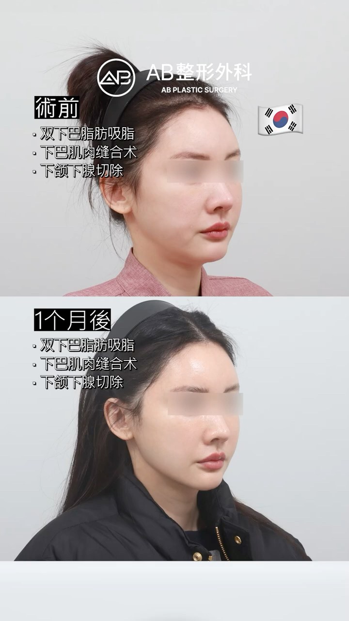 為什麼雙下巴手術要來韓國？真實前後對比 #shorts