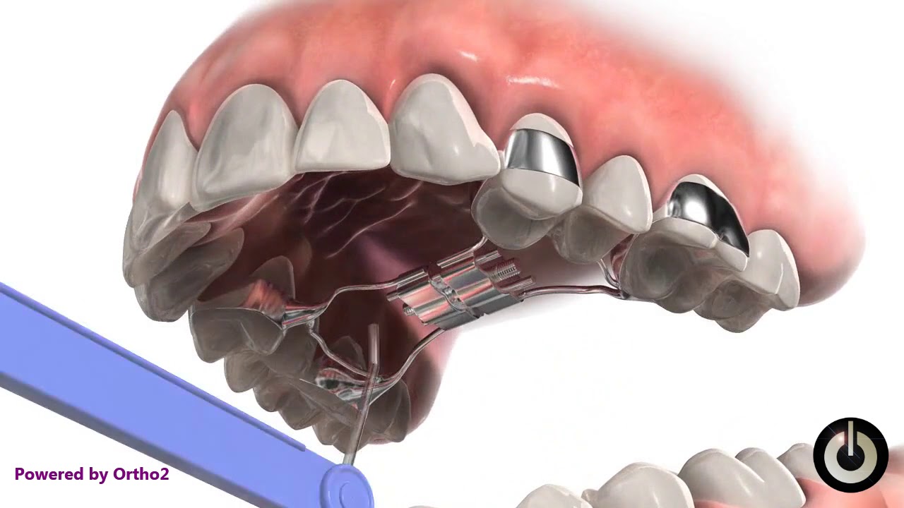 What is Palate Expander?