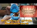 Pustiso with Retainer, Upper and Lower Hawley Retainers. Dentures with retainers