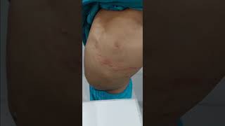 Herpes zoster || shingles #HZ #shingles