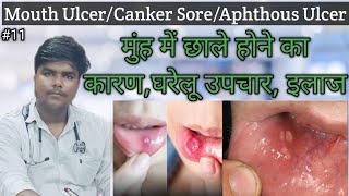 Mouth Ulcer(मुंह के छाले)Aphthous Ulcer | Canker Sore  || Causes,Home Remedies,Treatment pharmacy