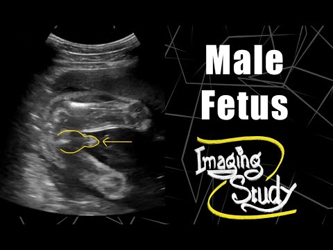 Male Fetus -