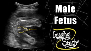 Male Fetus - Its a Boy || Ultrasound || Case 68